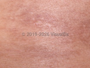 Hereditary coproporphyria