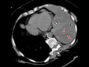 Pleural effusion
