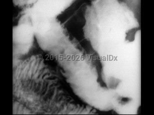 Yersinia enterocolitica infection