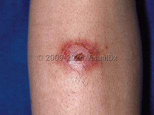 Clinical image of Spider bite - imageId=76956. Click to open in gallery.  caption: 'An eroded, erythematous nodule on the shin.'