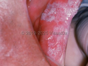 Clinical image of Leukoplakia - imageId=779107. Click to open in gallery.  caption: 'A sizeable white plaque on the buccal mucosa.'