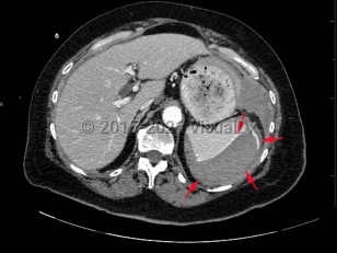 Imaging Studies image of Splenic rupture - imageId=7872924. Click to open in gallery.  caption: '<span>Axial CT image of the abdomen  demonstrates a large subcapsular splenic hematoma, with evidence of  active contrast extravasation and hemoperitoneum. Findings were  consistent with splenic rupture.</span>'