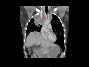 Superior vena cava syndrome