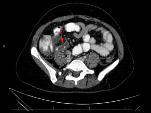 Imaging Studies image of Acute appendicitis - imageId=7873162. Click to open in gallery.  caption: 'Contrast enhanced&nbsp;axial image from CT scan&nbsp;demonstrating distended appendix with appendicolith.'