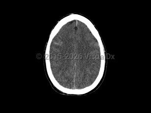 Cerebral edema