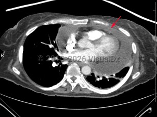 Cardiac tamponade
