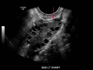 Polyendocrine metabolic ovarian syndrome