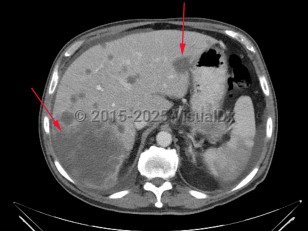 Imaging Studies image of Liver cancer - imageId=7884783. Click to open in gallery.  caption: '<span>Large low attenuation lesion in  the right lobe of the liver as well as several other smaller low  attenuation lesions consistent with metastatic disease to the liver.</span>'