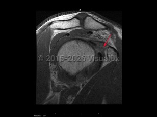 Imaging Studies image of Adhesive capsulitis of the shoulder - imageId=7887104. Click to open in gallery.  caption: '<span>Sag proton density MRI  sequence demonstrates scarring in the region of the rotator interval fat  which is a secondary sign of adhesive capsulitis.</span>'
