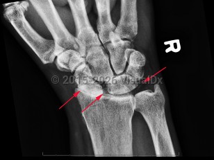 Calcium pyrophosphate deposition disease