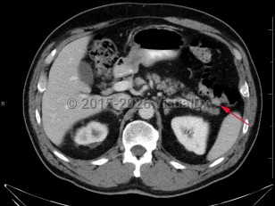 Imaging Studies image of Colonic polyps - imageId=7904556. Click to open in gallery.  caption: '<span>Axial CT image demonstrates a  soft tissue density at the splenic flexure. Subsequent colonoscopy  findings were consistent with colonic polyp.</span>'