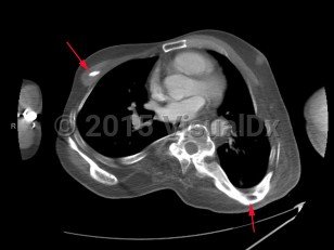 Imaging Studies image of Progressive osseous heteroplasia - imageId=7908380. Click to open in gallery.  caption: '<span>Axial CT of the chest  demonstrating multiple areas of heterotopic bone formation within the  chest wall musculature and ligaments, compatible with myositis ossificans  progressiva.</span>'