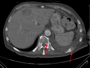 Pathologic fracture