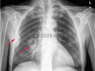 Lung cancer