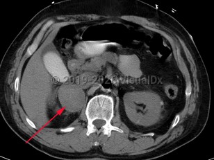 Pheochromocytoma