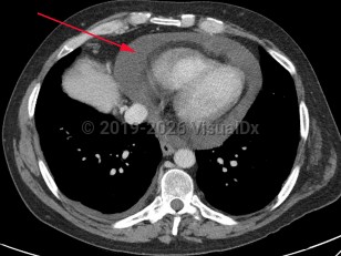 Pericardial effusion