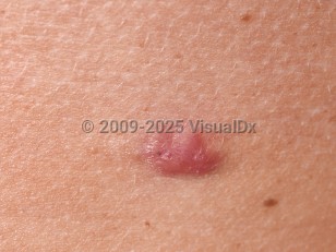 Clinical image of Eccrine poroma - imageId=79550. Click to open in gallery.  caption: 'A close-up of a smooth, deep pink papule.'