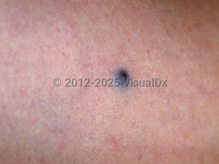 Clinical image of Glomus tumor - imageId=80028. Click to open in gallery.  caption: 'A close-up of a deep blue-purple papule with a lighter border.'