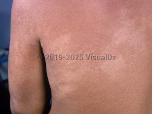 Clinical image of Nevus depigmentosus - imageId=807042. Click to open in gallery.  caption: 'Subtle, large, hypopigmented patches with feathery borders, on the back and arm.'