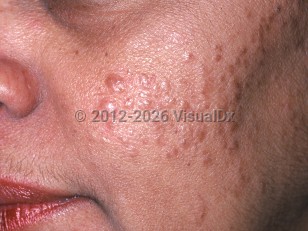 Clinical image of Osteoma cutis - imageId=812096. Click to open in gallery.  caption: 'Numerous shiny light brown papules on the cheek.'