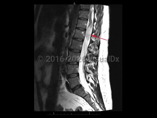 Imaging Studies image of Cauda equina syndrome - imageId=8332657. Click to open in gallery.  caption: '<span>Sag T2 MRI sequence of the  lumbar spine demonstrates a mass with increased T2 signal involving the  terminal aspects of the conus medullaris, with expansion of the cord and  perilesional edema. This mass was found to represent an astrocytoma, and  was resulting in symptoms of cauda equina syndrome secondary to  compression of the cauda equina.</span>'