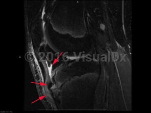 Imaging Studies image of Osgood-Schlatter disease - imageId=8337407. Click to open in gallery.  caption: '<span>Sag intermediate weighted fat  saturated MRI sequence demonstrates bone marrow edema in the region of  the fragmented tibial tubercle, with adjacent patellar tendonosis, and  deep infrapatellar bursitis. These findings are compatible with Osgood  Schlatter disease.</span>'