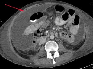 Peritonitis