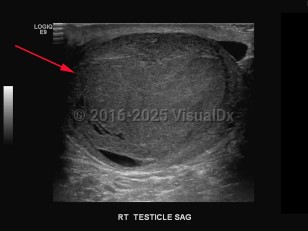 Imaging Studies image of Testicular cancer - imageId=8342371. Click to open in gallery.  caption: '<span>Grayscale ultrasound image of the right testicle demonstrating a large heterogeneous mass occupying the entire testicle. Pathology-proven classic seminoma.</span>'