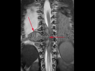 Imaging Studies image of Neuroblastoma - imageId=8343616. Click to open in gallery.  caption: '<span>T2 sagittal MRI of thorax showing large neuroblastoma along the mid thoracic spine.</span>'