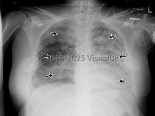 Imaging Studies image of Acute respiratory distress syndrome - imageId=8346315. Click to open in gallery.  caption: '<span>Single portable recumbent AP  view of the chest. A second radiograph obtained 8 hours after initial  radiograph demonstrates diffuse, bilateral airspace opacities, left  greater than right (straight black arrows). In the left hemithorax,  where fewer airspace opacities obscure the periphery of the lung, there  is no convincing evidence of Kerley B lines or pleural thickening (as  one might see in hydrostatic pulmonary edema).</span>'