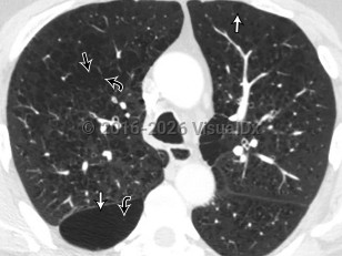 Chronic obstructive pulmonary disease