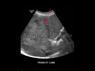 Hepatocellular carcinoma