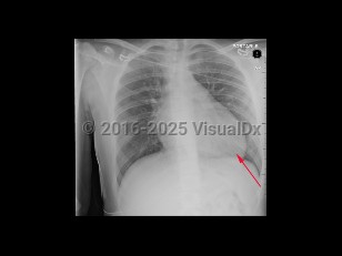 Imaging Studies image of Hypertrophic cardiomyopathy - imageId=8359232. Click to open in gallery.  caption: '<span>AP view of the chest demonstrating an enlarged heart in this patient with diagnosed hypertrophic cardiomyopathy.</span>'