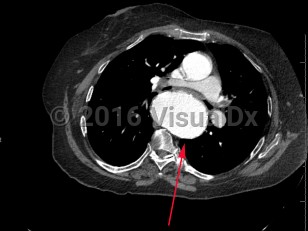 Imaging Studies image of Thoracic aortic aneurysm - imageId=8361372. Click to open in gallery.  caption: '<span>Axial image from enhanced CT scan of the chest showing a large aneurysm of the descending thoracic aorta.</span>'