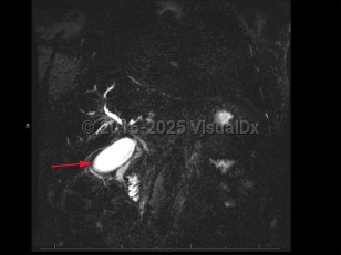 Imaging Studies image of Cholangiocarcinoma - imageId=8368519. Click to open in gallery.  caption: '<span>MCRP demonstrates peripheral and central enhancement consistent with cholangiocarcinoma.</span>'