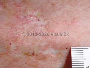 Clinical image of Livedoid vasculopathy - imageId=84971. Click to open in gallery.  caption: 'A close-up of porcelain white, depressed scars with adjacent crusting and prominent telangiectasia.'