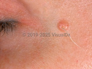 Clinical image of Trichofolliculoma - imageId=874496. Click to open in gallery.  caption: 'A pink papule with a central light gray hair egressing from it on the temple.'