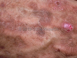 Clinical image of Variegate porphyria - imageId=887807. Click to open in gallery.  caption: 'A close-up of a pink scar with a superficial overlying crust and some surrounding atrophic hyperpigmented scars, on the dorsal hand.'
