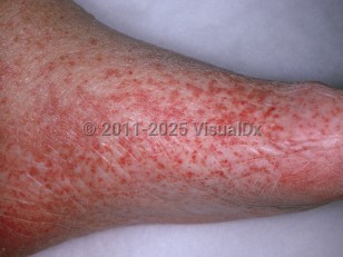 Clinical image of Leukocytoclastic vasculitis - imageId=893185. Click to open in gallery.  caption: 'Many petechiae and some purpuric patches on the foot.'