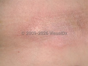 Clinical image of Morphea - imageId=92937. Click to open in gallery.  caption: 'A close-up of a shiny and wrinkled, white and yellowish plaque with a pink rim.'