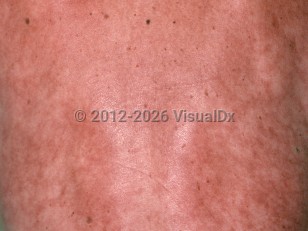 Angioendotheliomatosis