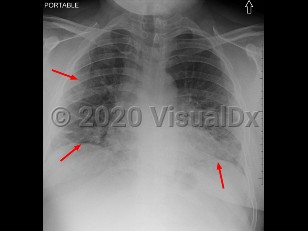 Imaging Studies image of COVID-19 - imageId=9733688. Click to open in gallery.  caption: 'Multifocal areas of airspace disease predominantly involving the lower lobes, compatible with multifocal pneumonia. SARS-CoV-2+.'